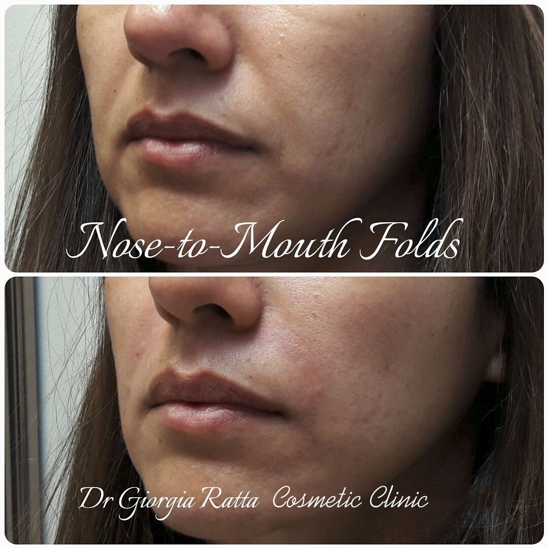 Dr Giorgia Ratta - before and after treatment image