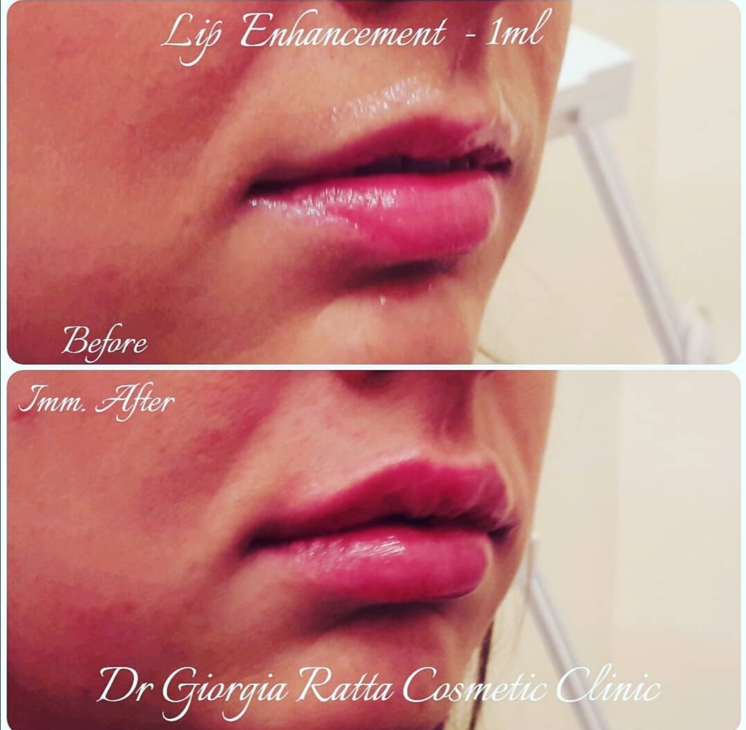 Dr Giorgia Ratta - before and after treatment image