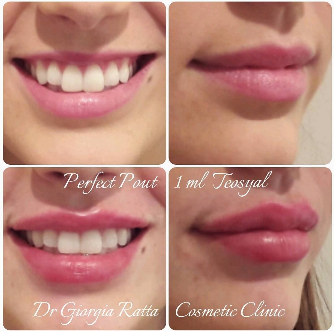 Dr Giorgia Ratta - before and after treatment image