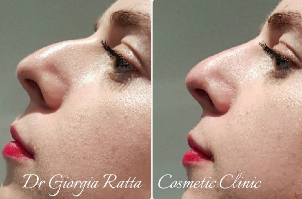 Dr Giorgia Ratta - before and after treatment image