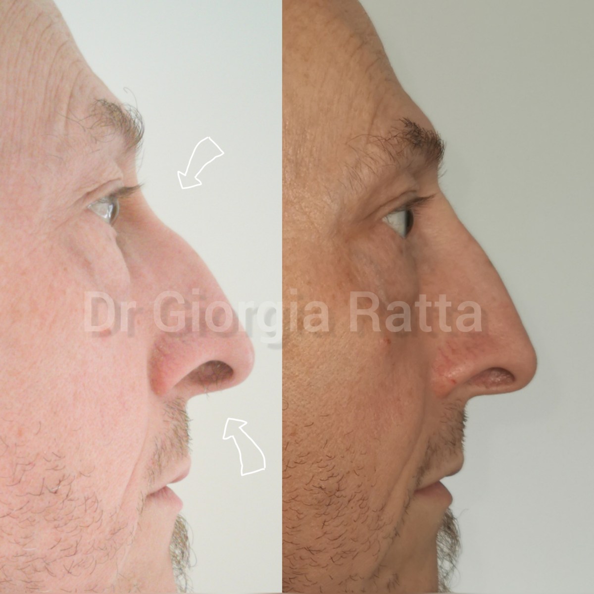 Dr Giorgia Ratta - before and after treatment image