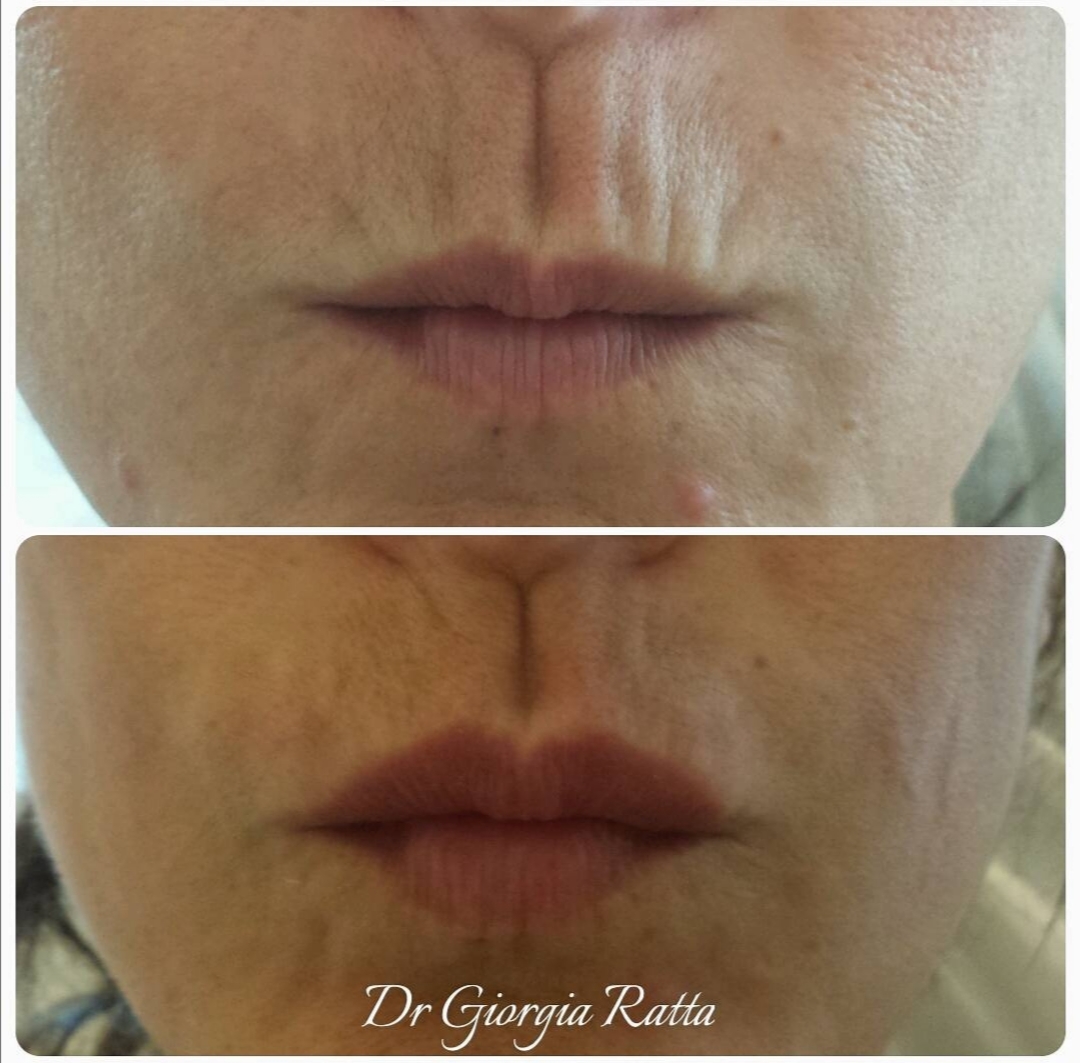 Dr Giorgia Ratta - before and after treatment image