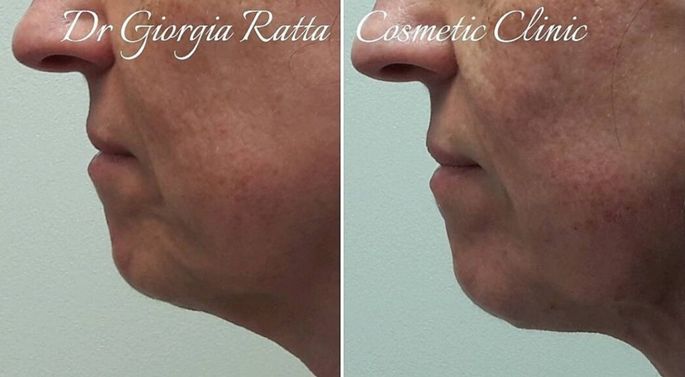 Dr Giorgia Ratta - before and after treatment image