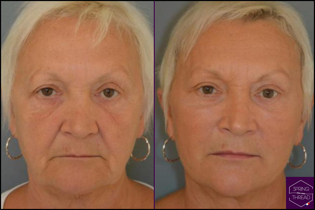 Dr Giorgia Ratta - Generation Aesthetics Clinics - Spring Thread Lift